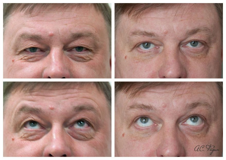 Блефаропластика у мужчин фото до и после