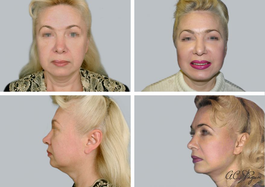 Иглоукалывание для лица как подтяжка фото до и после