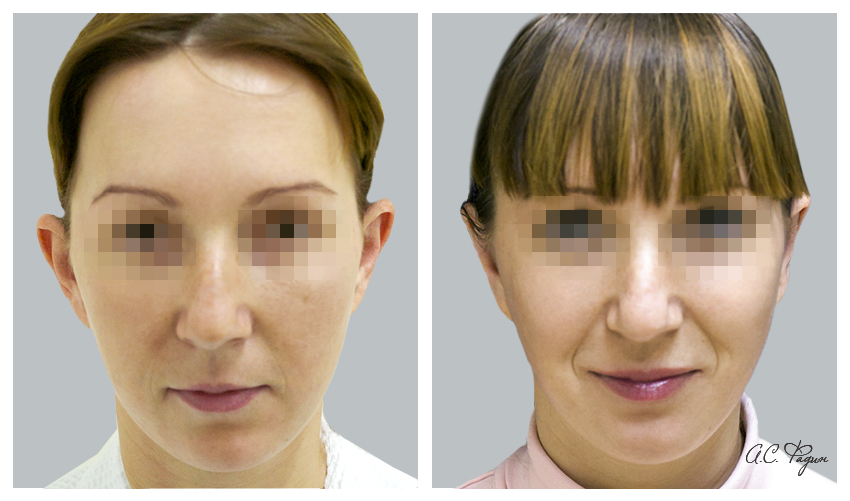 Otoplasty: photo before and after