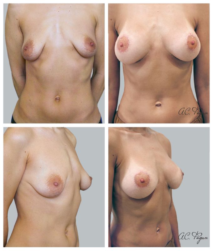 Увеличение груди имплантатами с подтяжкой груди