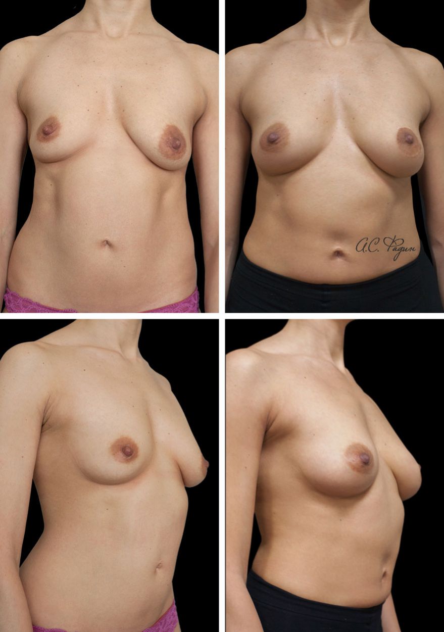 как выглядят груди после кормления грудью фото (120) фото