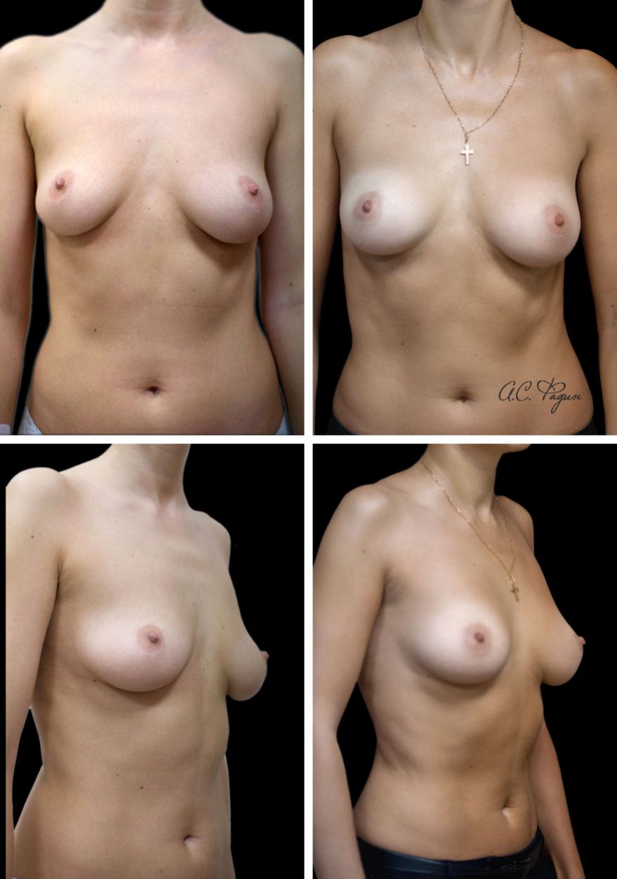 голая грудь после родов фото до и после фото 23