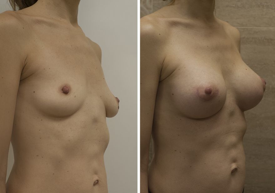 Увеличение груди имплантатами